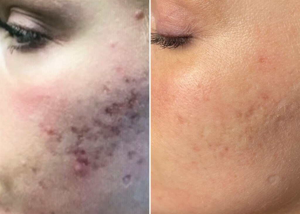 Skinpen Microneedling Photos Houston Tx Patient