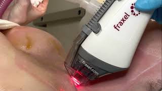 Fraxel Laser Skin Treatment From Start To Finish