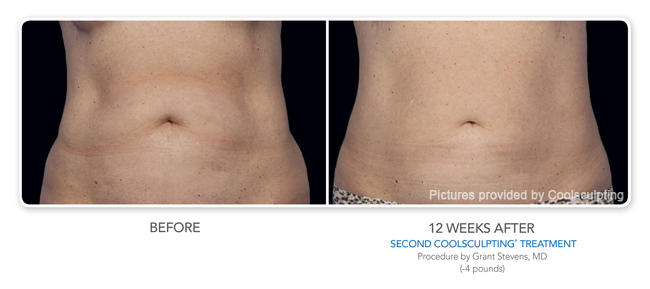 treatment 3d skin TX CoolSculpting Houston,