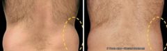 CoolSculpting Before and After Photos in Houston, TX, Patient 7859