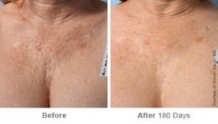 Ulthera Lift Before and After Photos in Houston, TX, Patient 8179