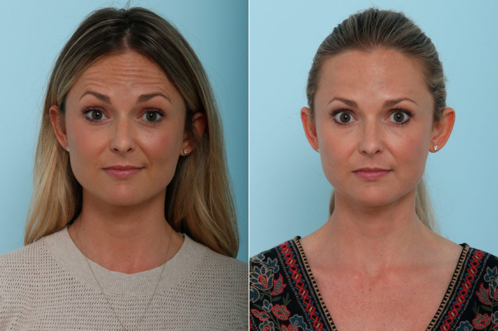 Botox® Cosmetic And Xeomin Photos Houston Tx Patient 9401 