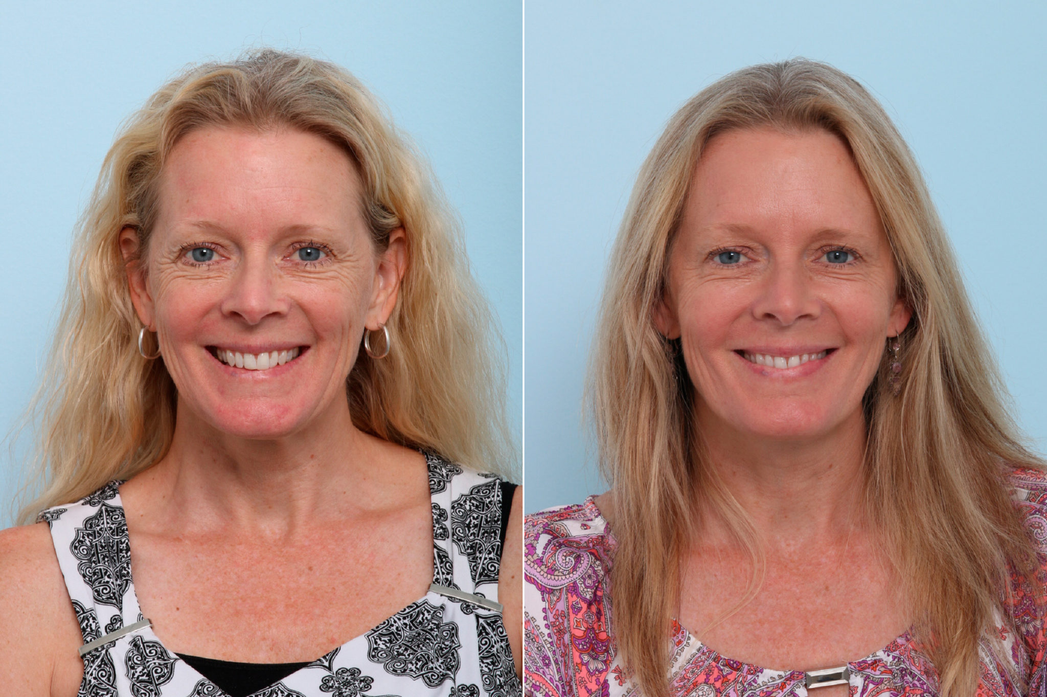 Botox® Cosmetic & Xeomin Photos | Houston, Tx | Patient 7750