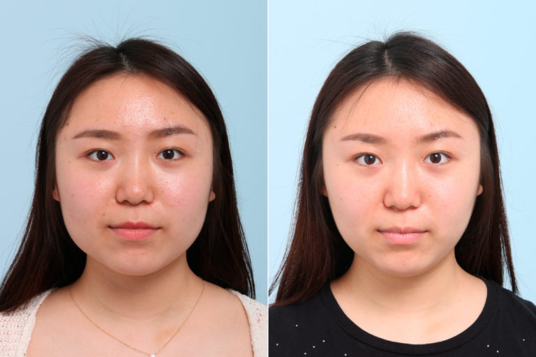 Botox® Cosmetic Photos | Houston, Tx | Patient 7764