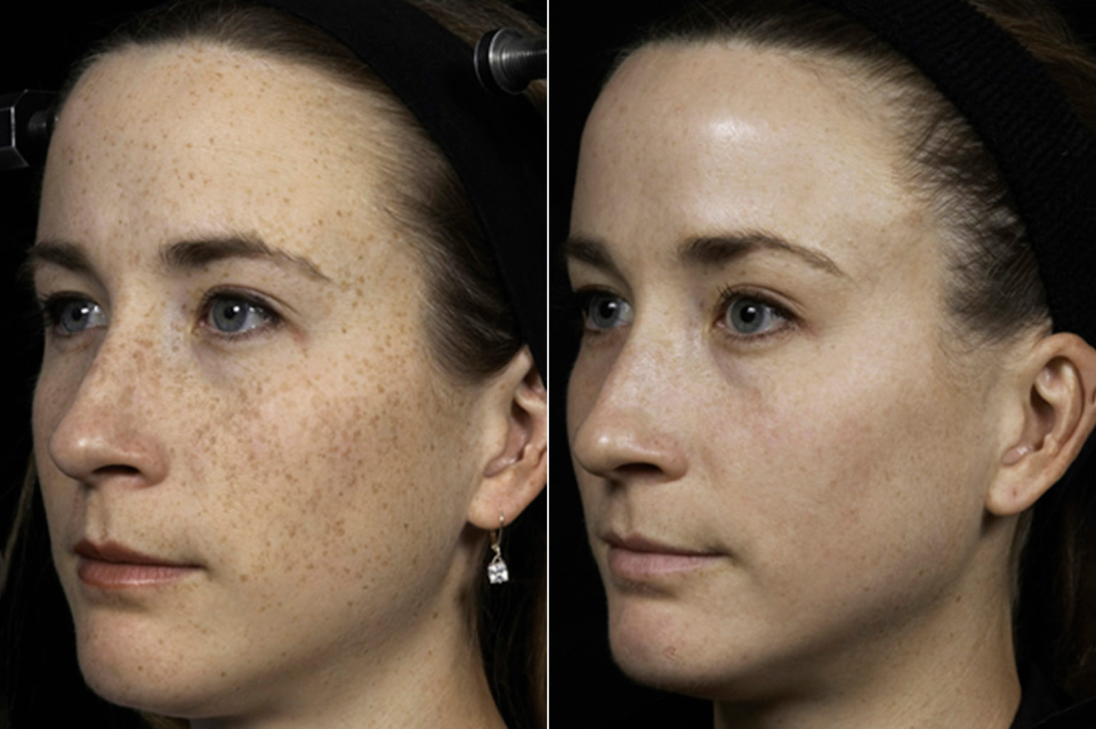 Fraxel Skin Resurfacing Advanced Facial Treatment Houston, TX