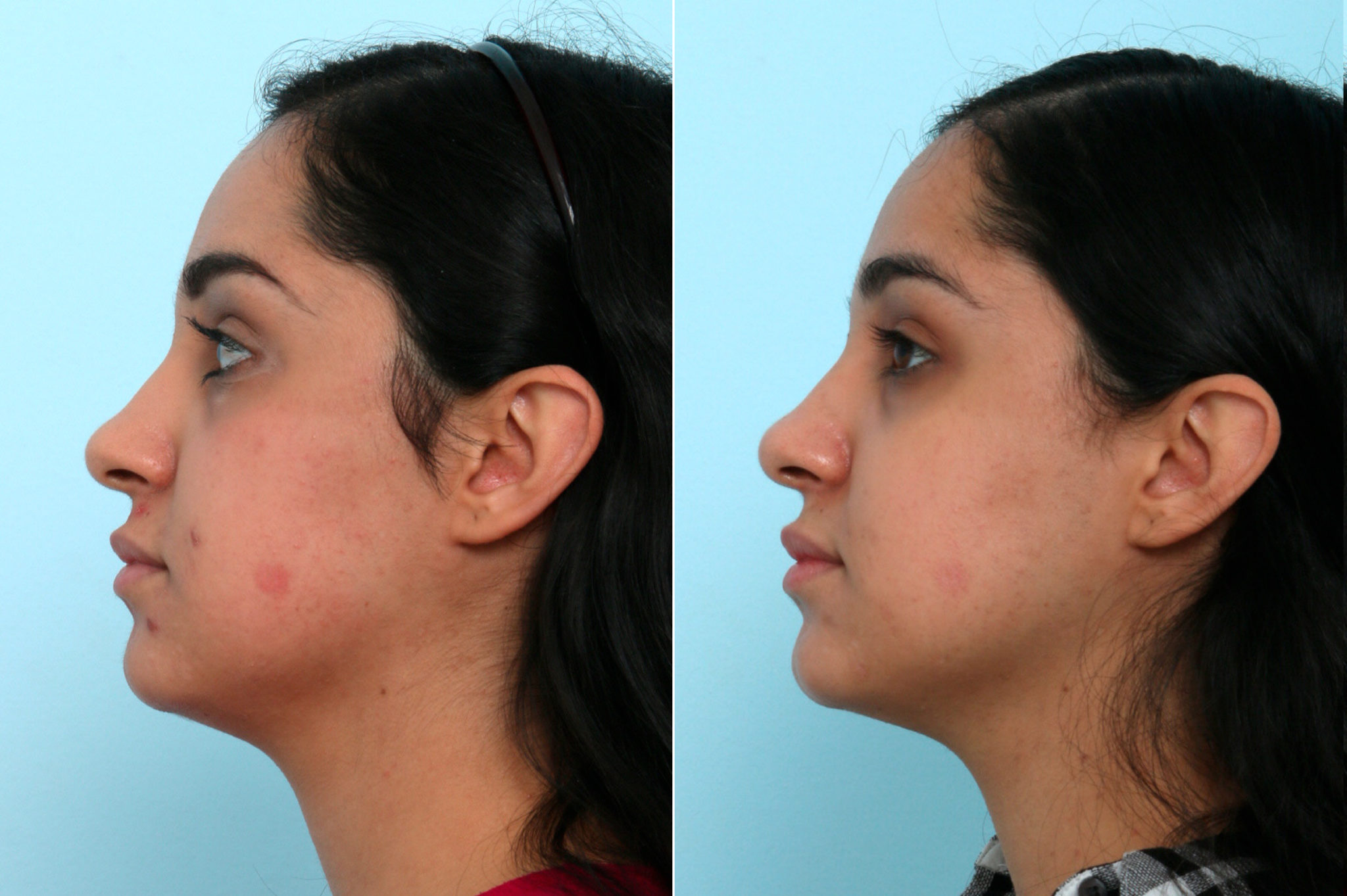 Fraxel Laser Before And After Photo Gallery