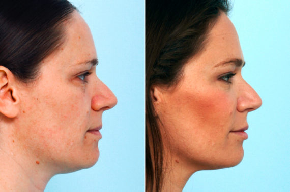 How to Get a Better Jawline - Procedures for a Chiseled Jaw