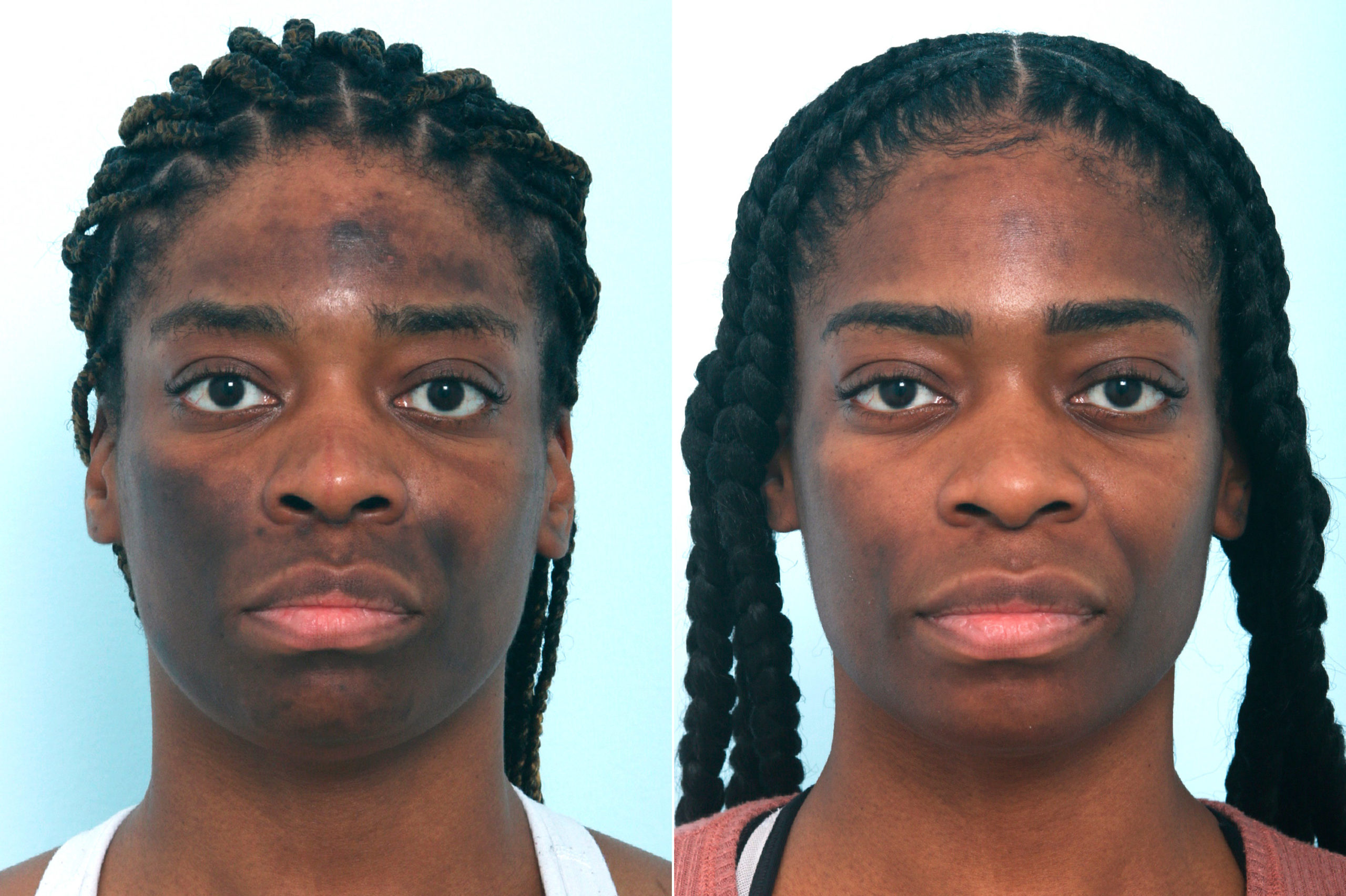 Chemical Peels Photos Houston Tx Patient 10039