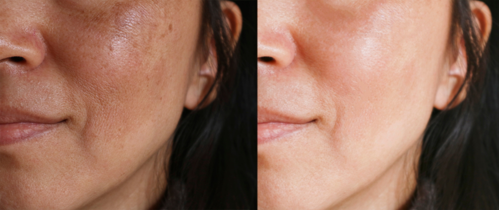 All About Brown Spots Houston Tx