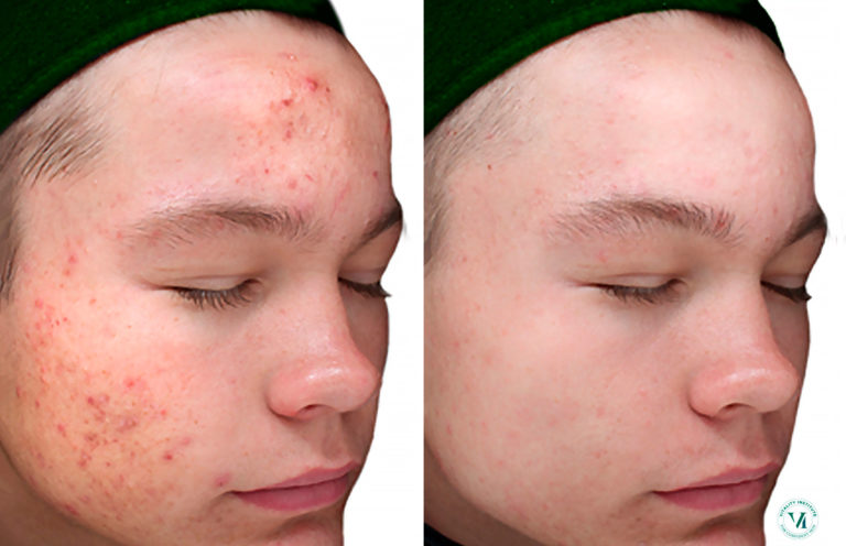 Chemical Peels Before and After photo gallery