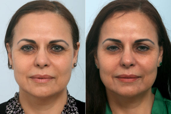 How to Achieve a Chiseled Jawline - Zcosmetic Health