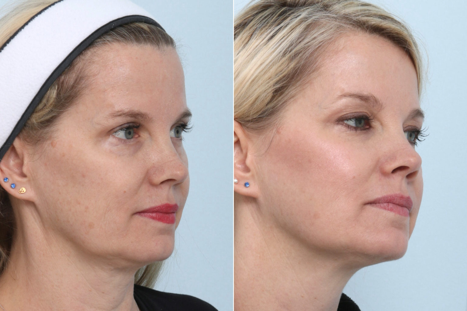 Thermage Vs Ultherapy What Is The Difference