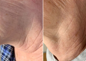 SkinPen® Microneedling Before and After Photos in Houston, TX, Patient 13642