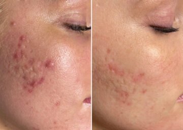 SkinPen® Microneedling Before and After Photos in Houston, TX, Patient 13631