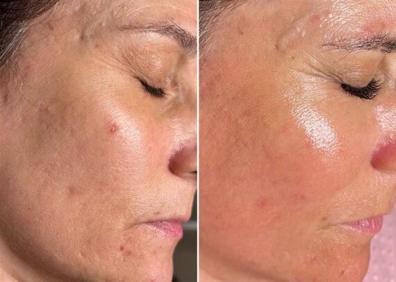 SkinPen® Microneedling Before and After Photos in Houston, TX, Patient 13628