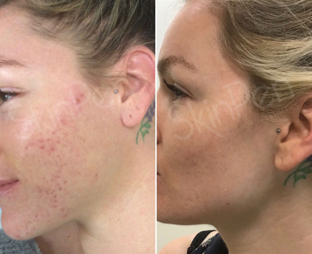 SkinPen® Microneedling Photos | Houston, Tx | Patient 13686