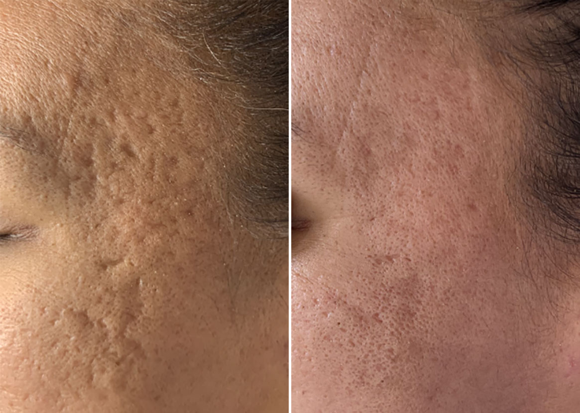 Skinpen® Microneedling Photos Houston Tx Patient 13616 5717