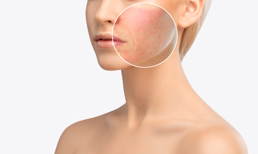 Close-up of a woman's face showing before and after results of Fraxel laser treatment on acne scars.