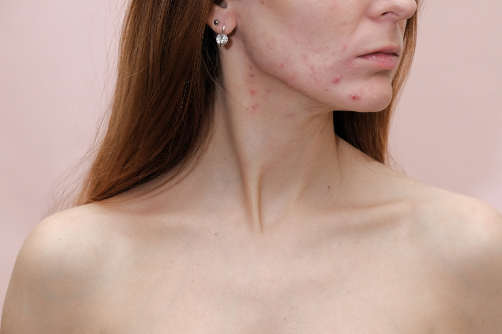 Side profile of a young woman with visible acne scars, highlighting the areas treated for collagen stimulation.