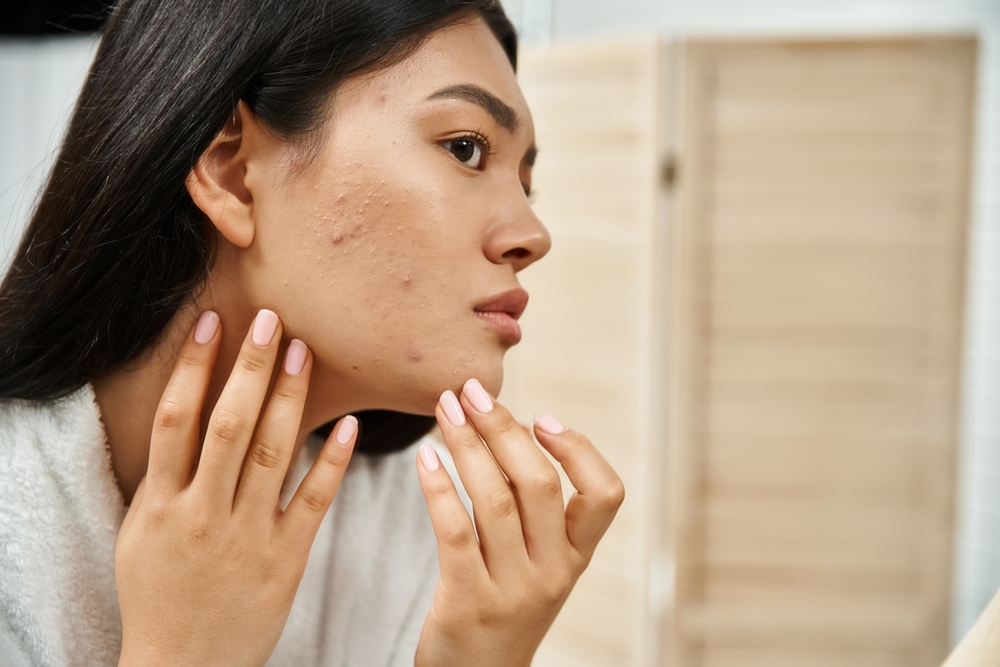 Young Asian woman examining her acne scars in the mirror, considering tailored Fraxel laser treatment options.