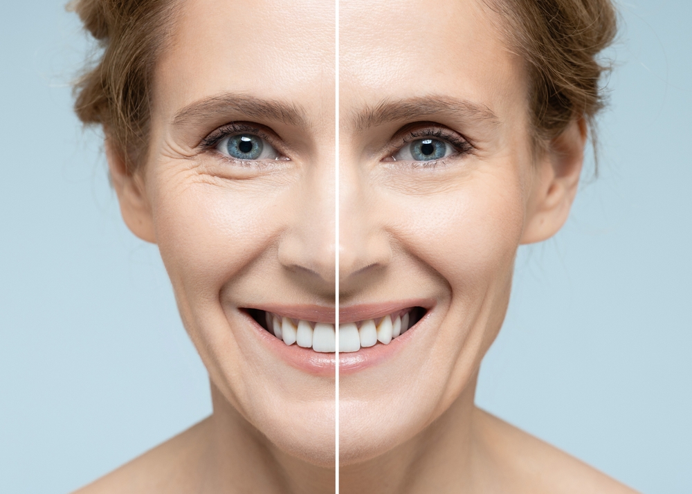 Side-by-side comparison of a woman's face showing before and after results of Fraxel laser treatment, highlighting skin rejuvenation.