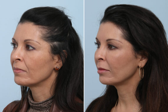 Fillers Before and After Photos in Houston, TX, Patient 8360