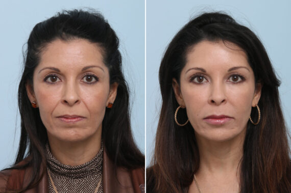 Fillers Before and After Photos in Houston, TX, Patient 8360