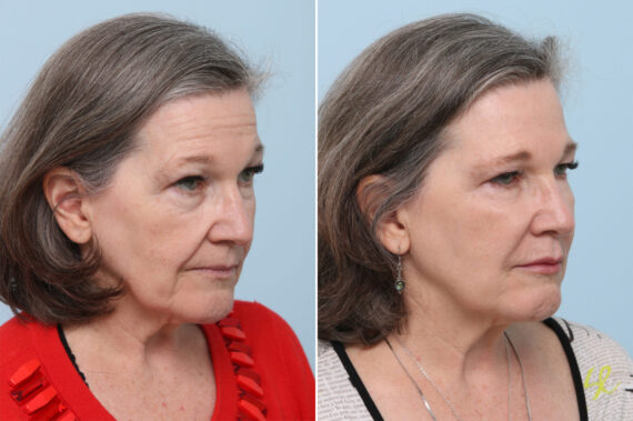 Fillers Before and After Photos in Houston, TX, Patient 8365