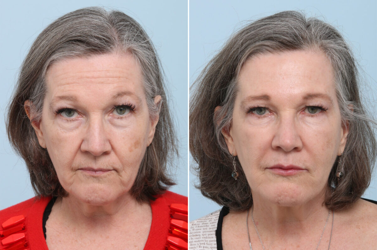 Fillers Before and After Photos in Houston, TX, Patient 8365