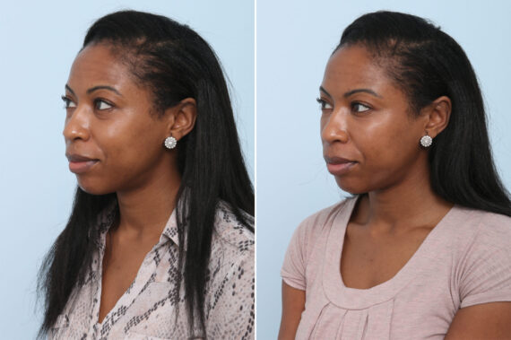 Fillers Before and After Photos in Houston, TX, Patient 8370