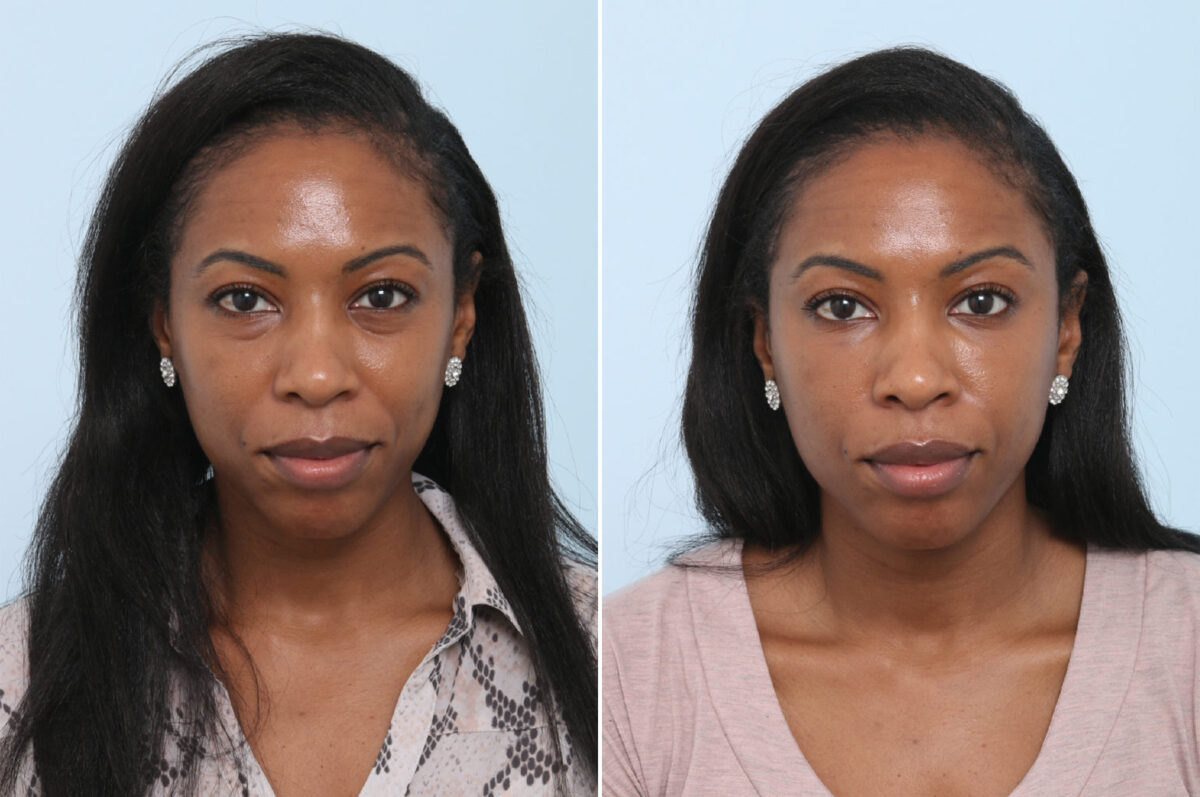 Fillers Before and After Photos in Houston, TX, Patient 8370