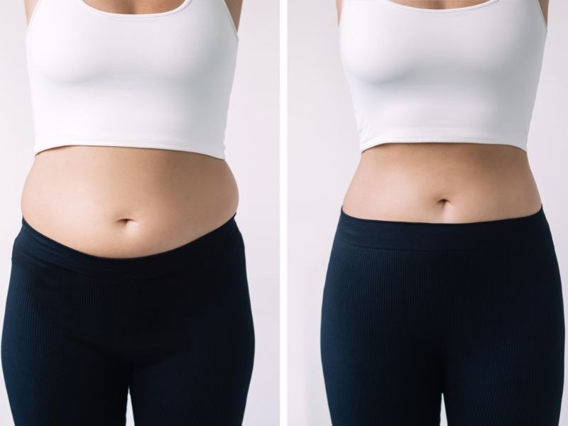 Side-by-side comparison of a CoolSculpting treatment showing before and after results with reduced abdominal fat.